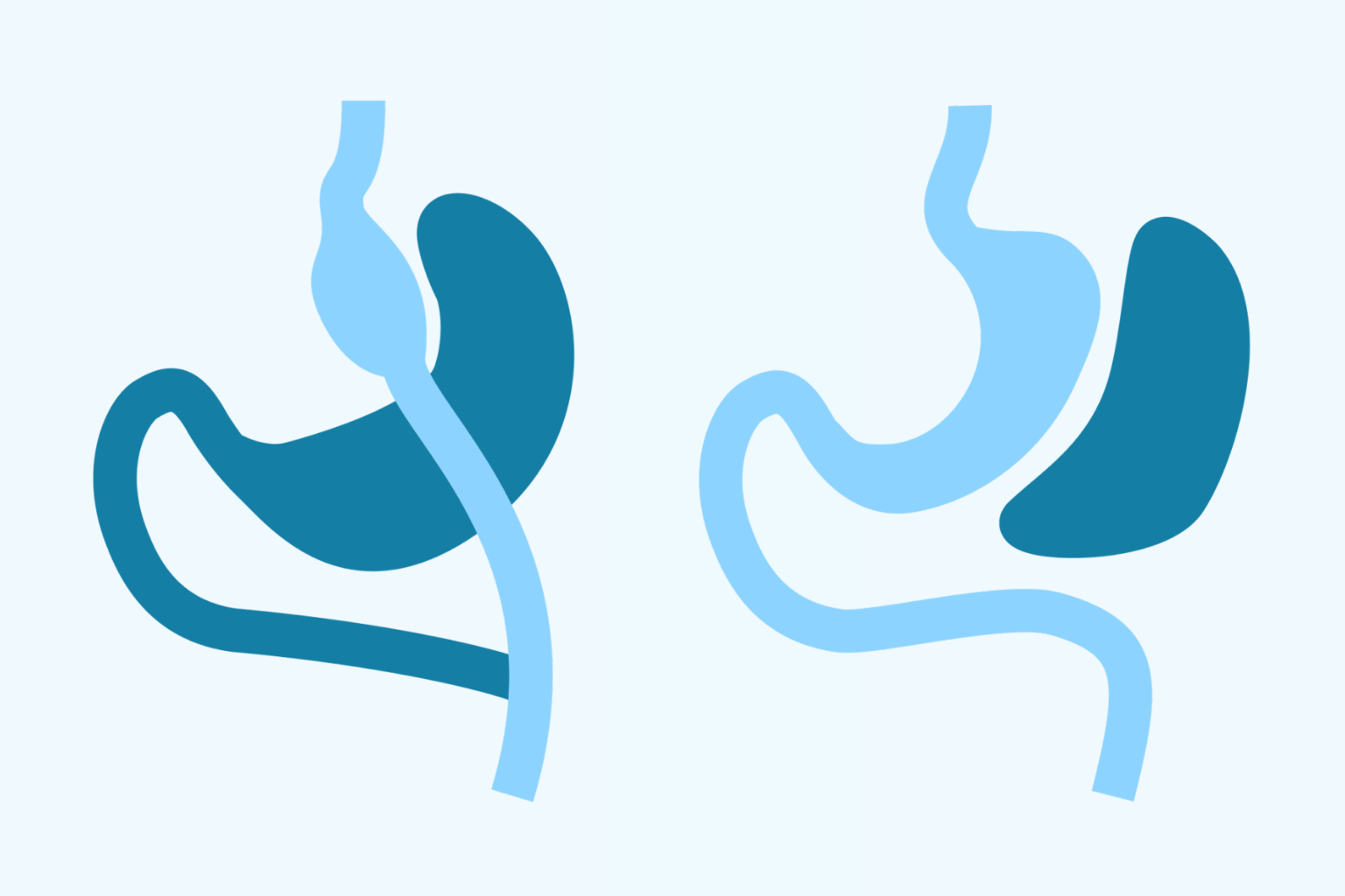 Gastric bypass och gastric sleeve – jämförelse