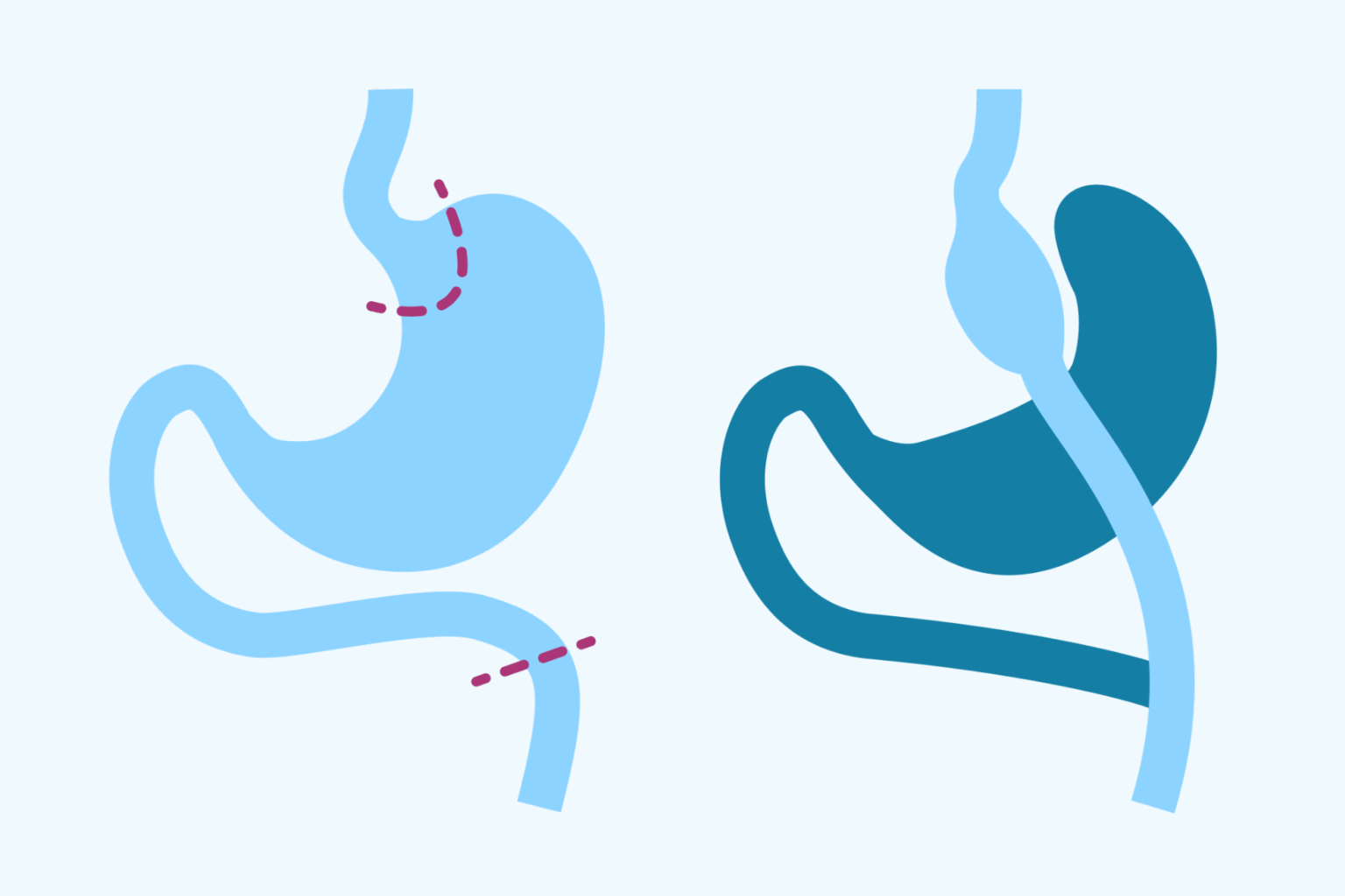Vad är gastric bypass?