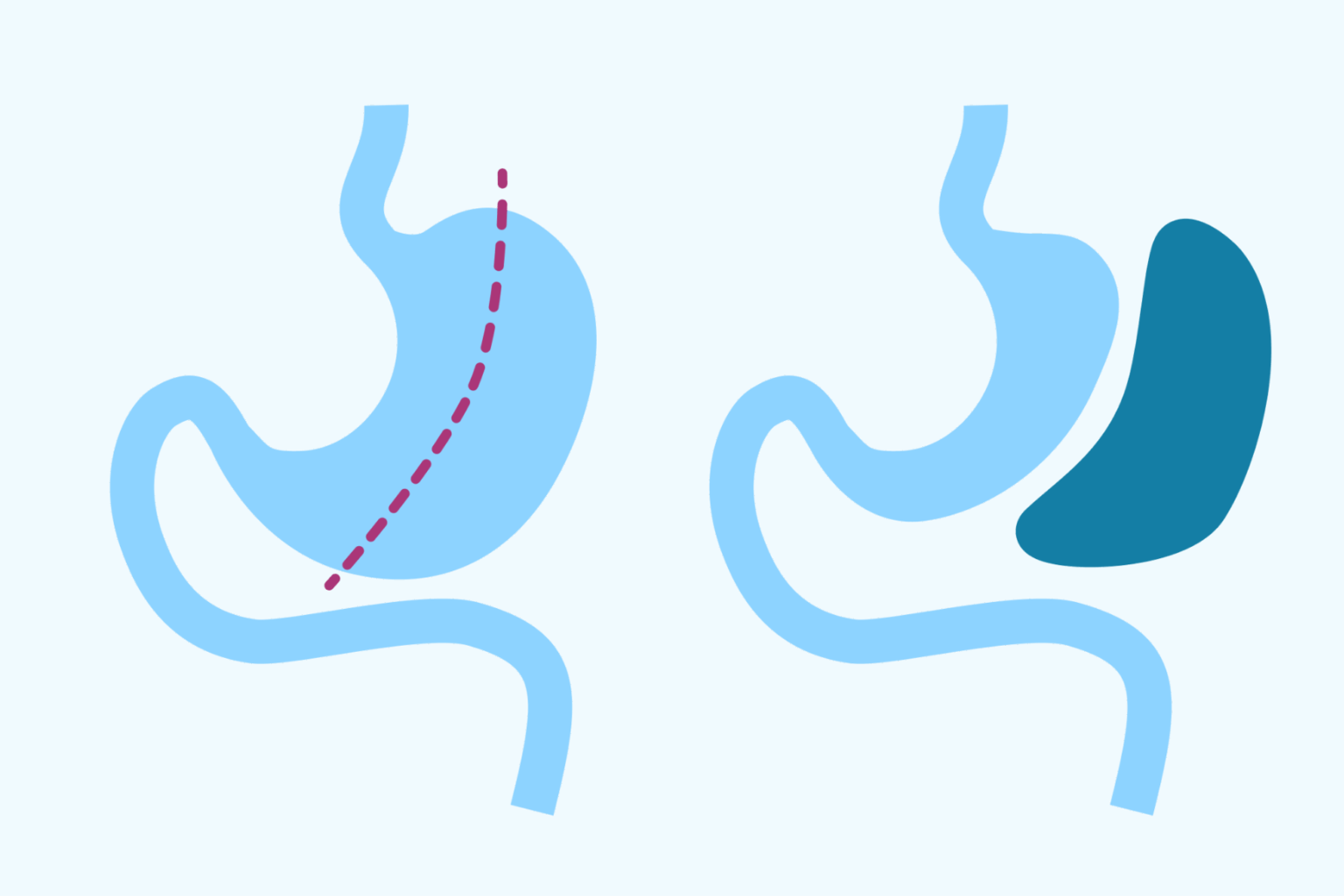 Vad är gastric sleeve?