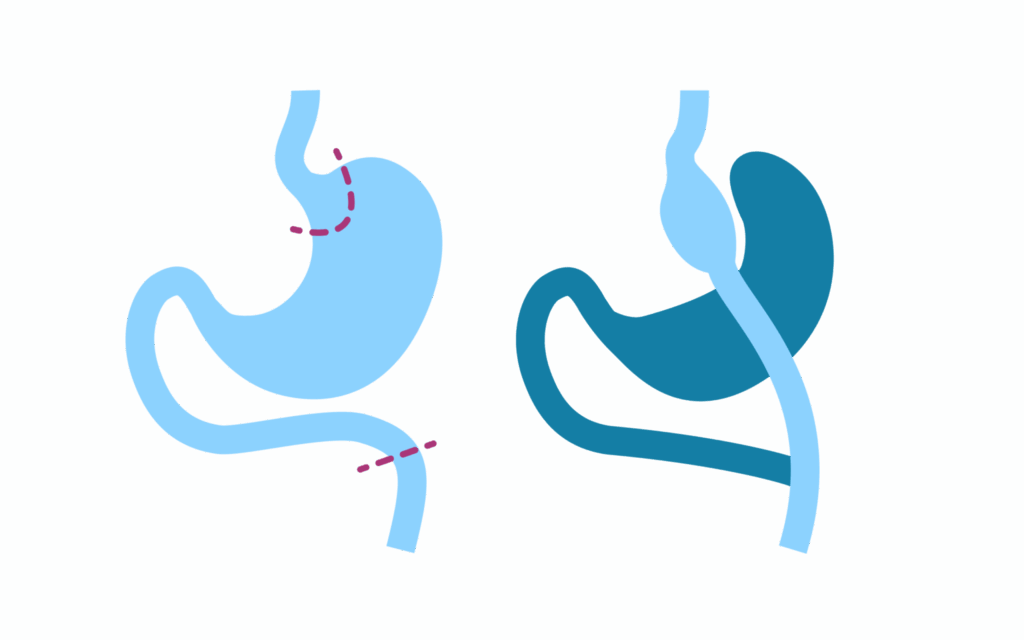 Illustration av en gastric bypass-operation, där en mindre magsäck skapas och kopplas direkt till tunntarmen för att minska näringsupptaget och främja viktminskning.