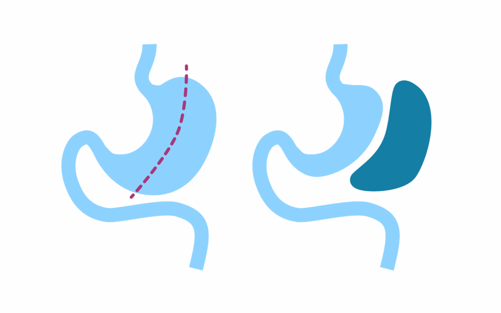 Illustration av en gastric sleeve-operation, där en stor del av magsäcken tas bort och en smalare magsäck formas för att minska matintaget.