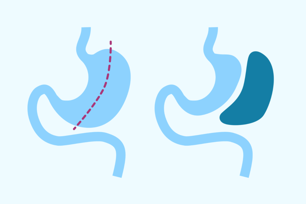Illustration över hur en Gastric sleeve-operation går till.